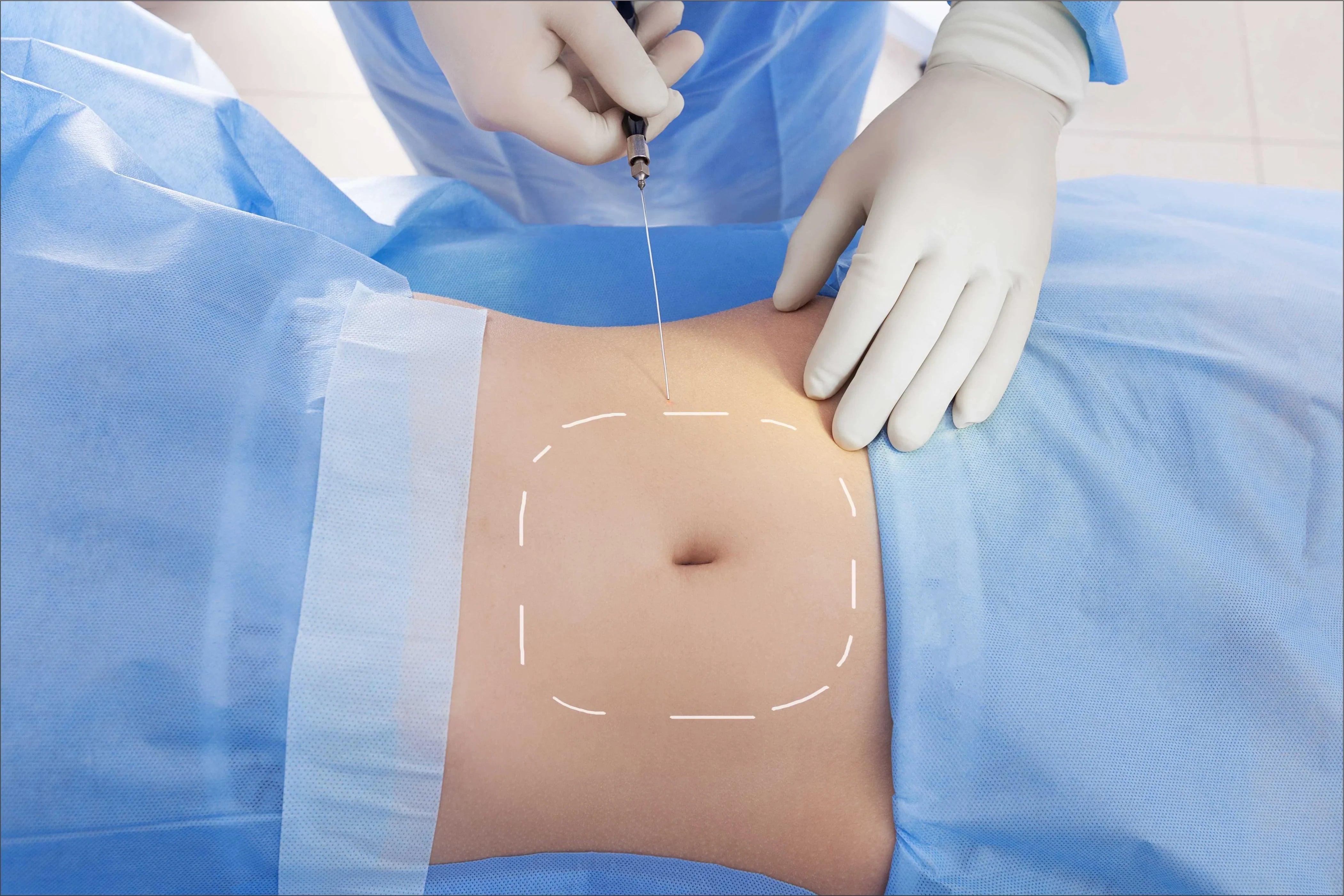 What to Expect: Liposuction Recovery Time and Tips. - Ameri Surgical Instruments Inc.